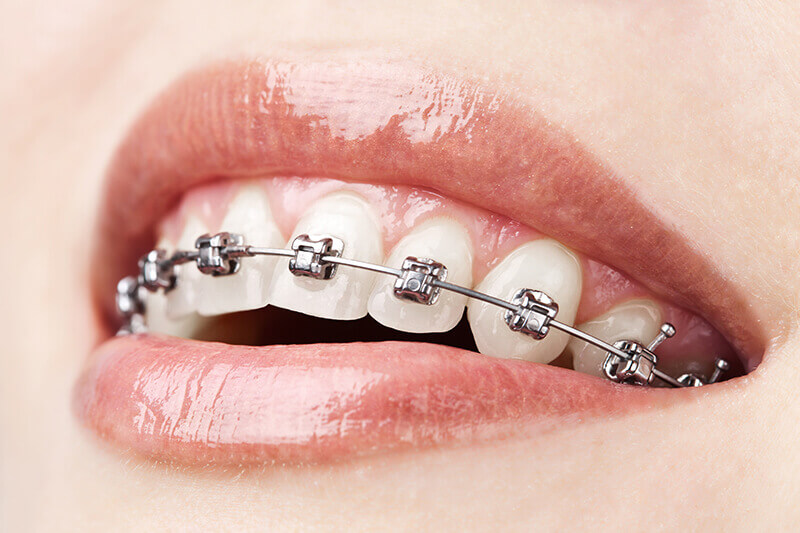 proimages/tooch/Fotolia_34145602_Subscription_XL.jpg 戴蒙矯正器